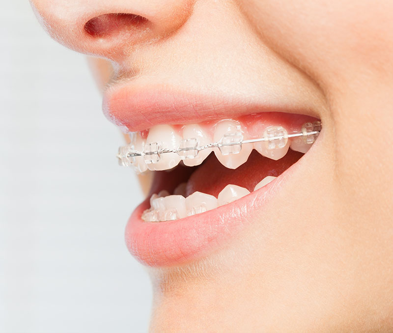Orthodontic Associates of New England | Early Treatment, Oral Hygiene and Common Treatments