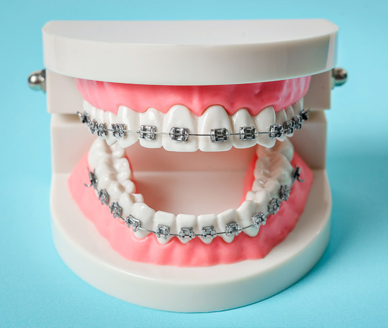 Orthodontic Associates of New England | Oral Hygiene, Adult Treatment and Invisalign reg 