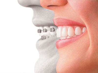 Orthodontic Associates of New England | Metal Braces, Early Treatment and Oral Hygiene